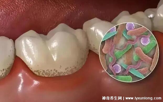 牙龈癌的早期三大症状图片