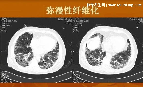 吸电子烟的肺部图片