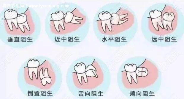 多生牙拔牙多少钱图片