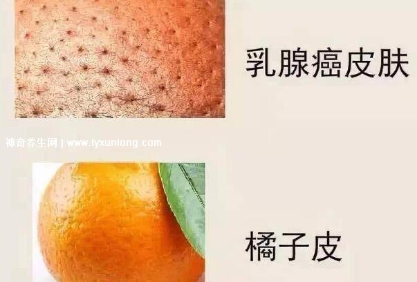 乳腺癌的症状 橘子皮图片