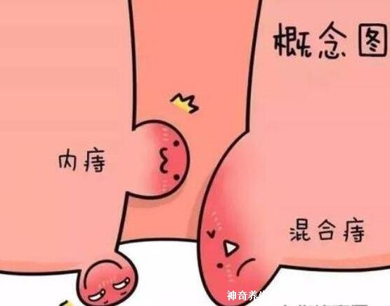 痔疮24种图片